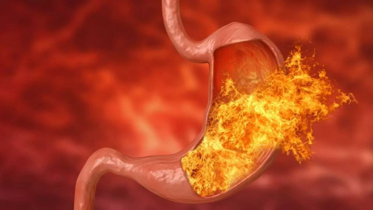 The Connection Between Acid Indigestion and H. pylori Infection