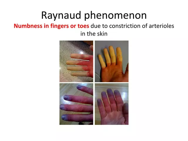 Azathioprine and the Risk of Raynaud's Phenomenon: A Comprehensive Review